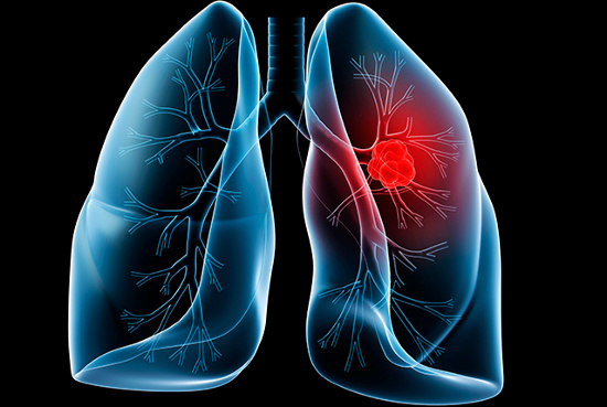 nấm lim xanh điều trị bênh ung thư phổi